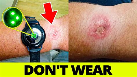 skin irritation from smart watch.